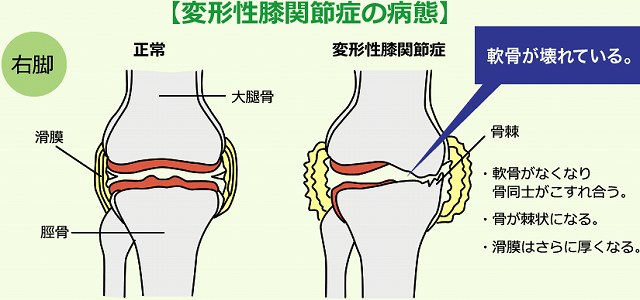 変形性膝関節症の症状