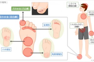 水虫の種類